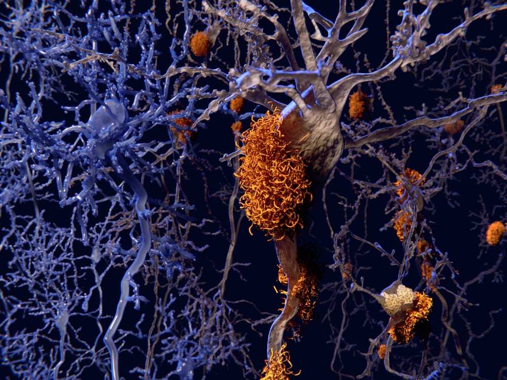 Alzheimer disease, neuron network with amyloid plaques