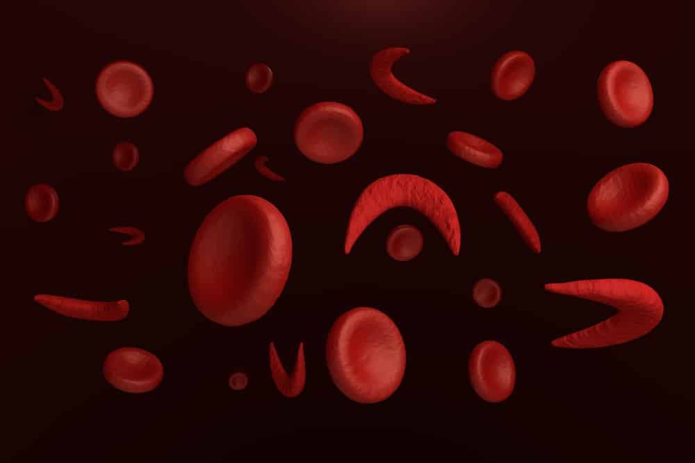 Normal cells and sickle cells