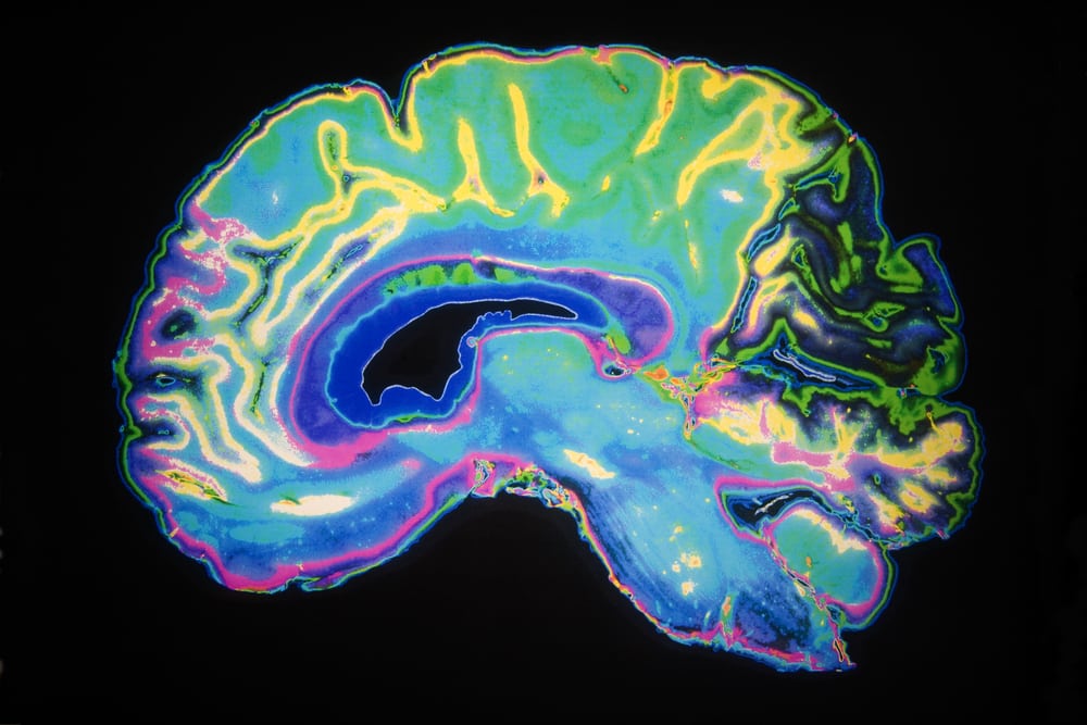 Colored MRI scan of human brain