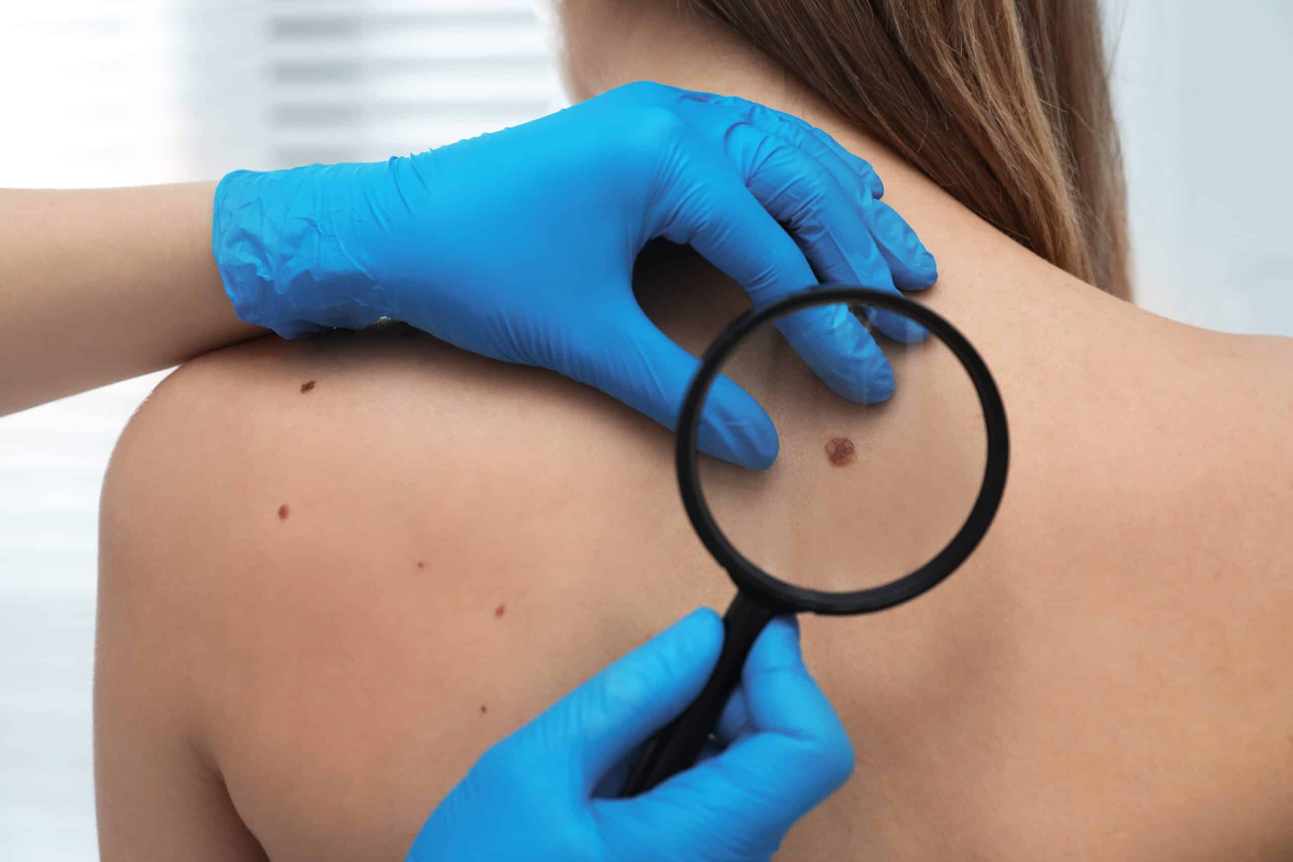 Dermatologist-examining-a-mole-on-the-back-of-a-patient