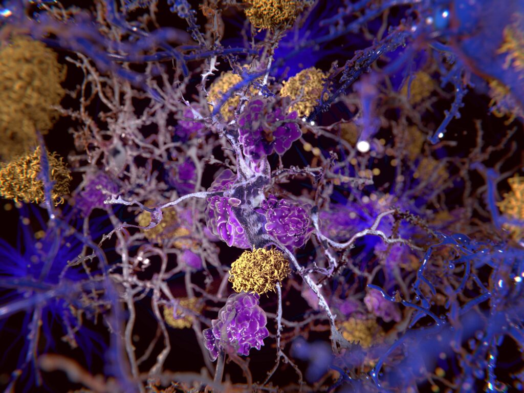 Graphic-illustration-of-alzheimers-disease-amyloid-plaques-damaging-neurons