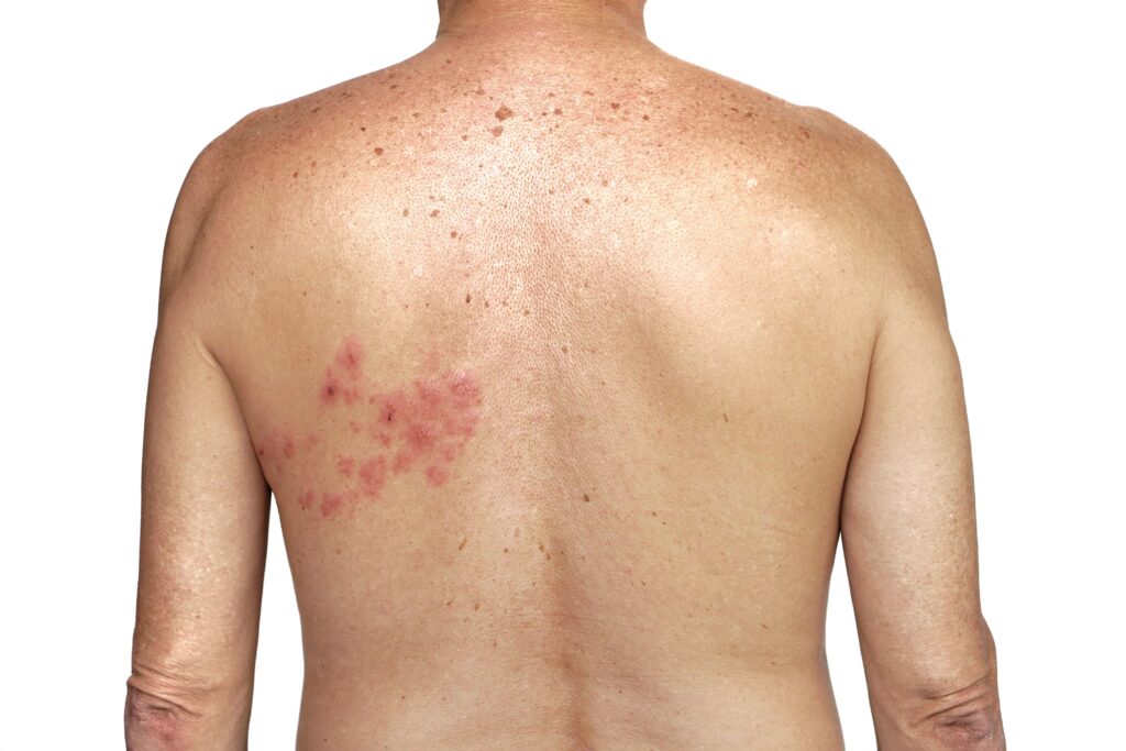 Shingles-virus-herpes-zoster-on-mans-back