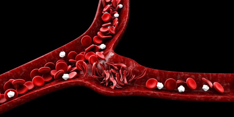 graphic illustration of sickle cell anemia showing blood vessel with normal and deformed cells