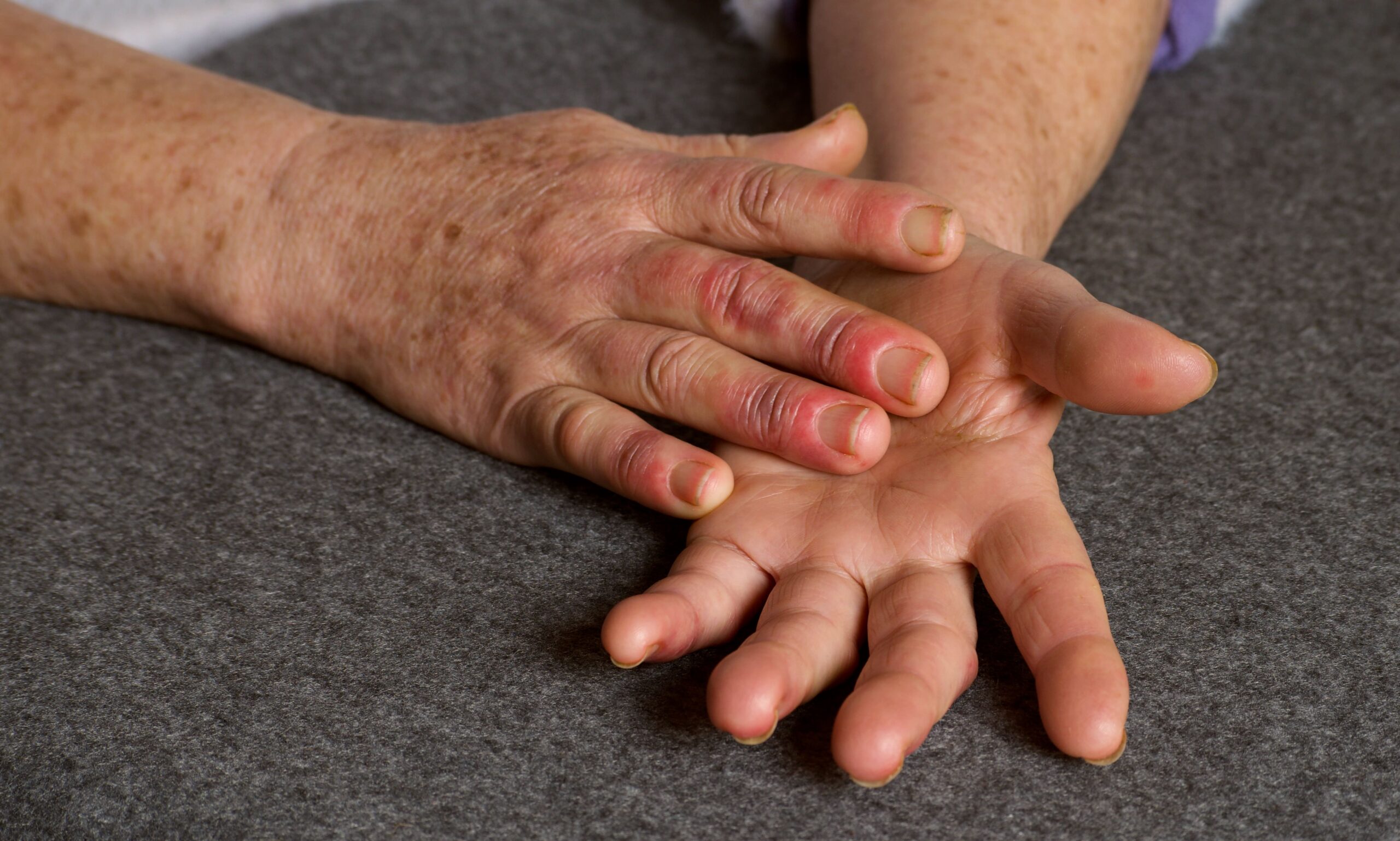 Reddened hands of woman with Raynauds syndrome