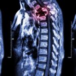 xray of spine metastasis