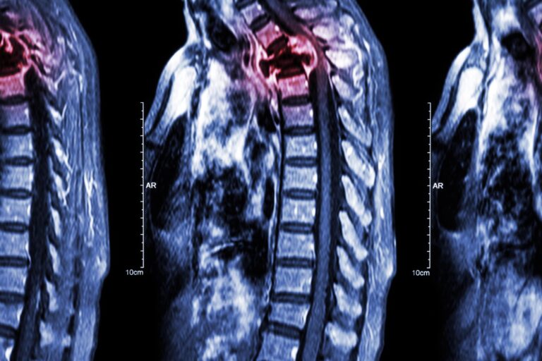 xray of spine metastasis
