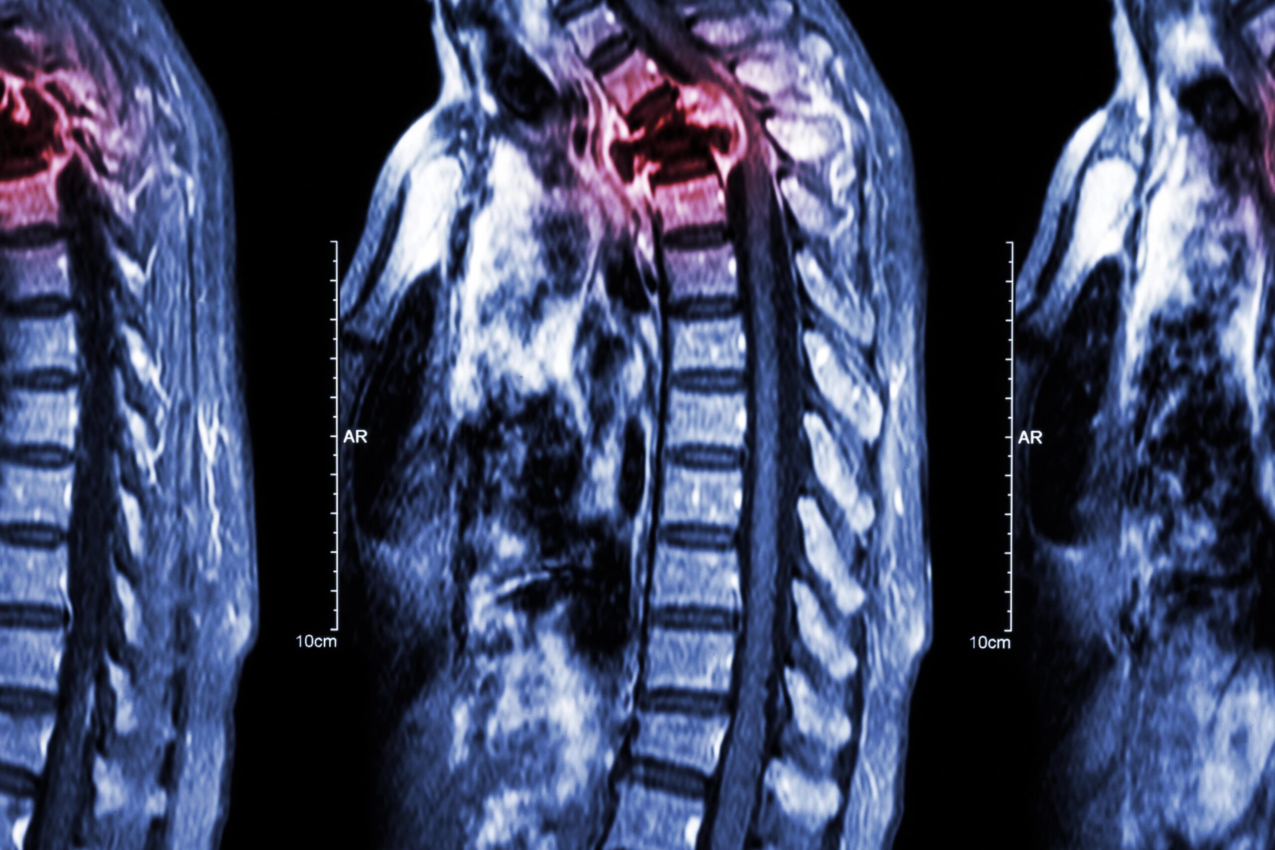 xray of spine metastasis