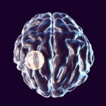 Brain abscess caused by parasite Toxoplasma gondii