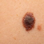 Close-up of nevus on skin, melanoma