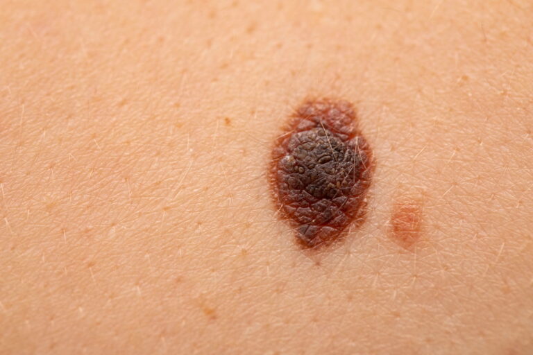 Close-up of nevus on skin, melanoma