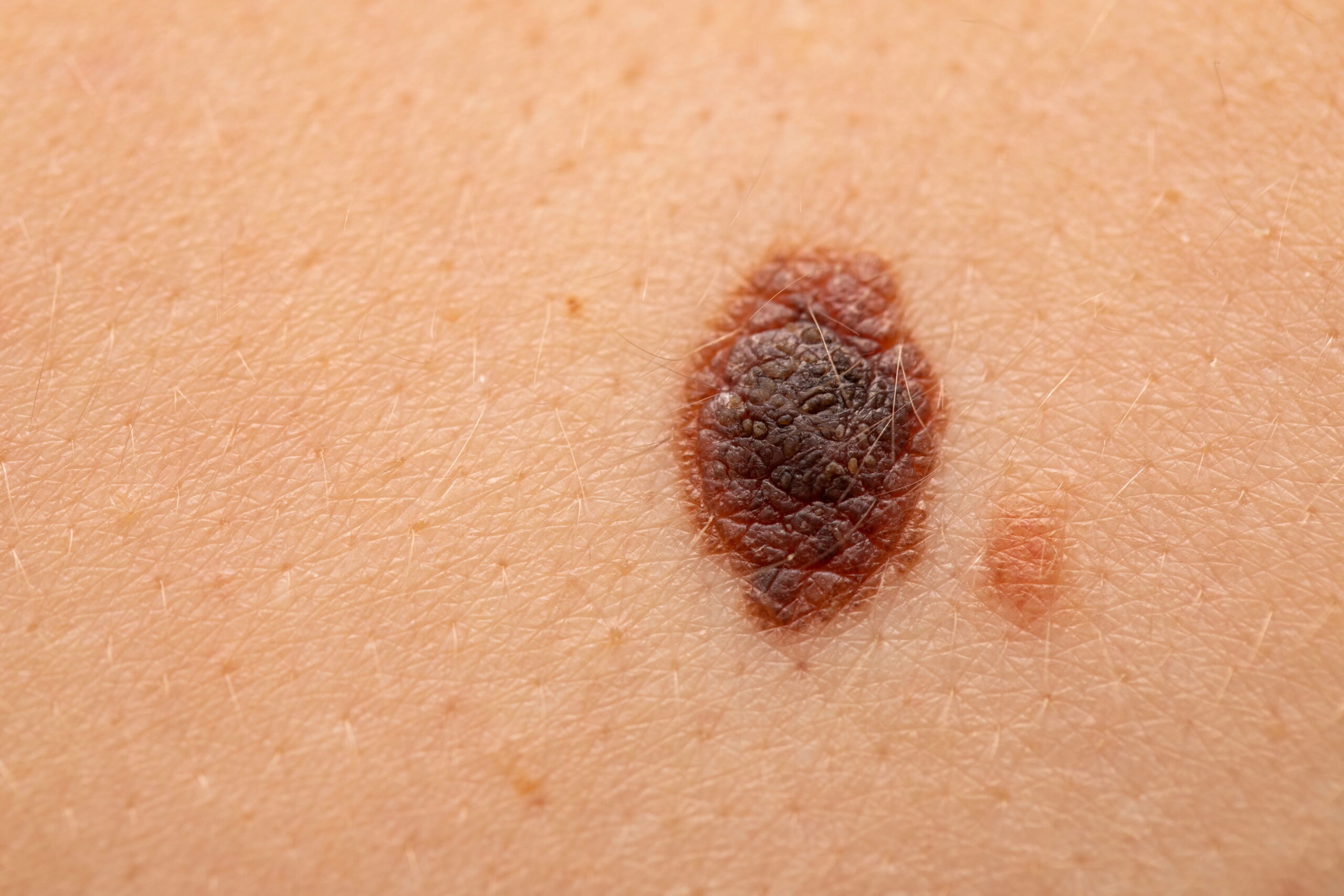 Close-up of nevus on skin, melanoma