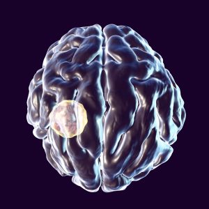 Brain abscess caused by parasite Toxoplasma gondii
