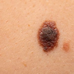 Close-up of nevus on skin, melanoma