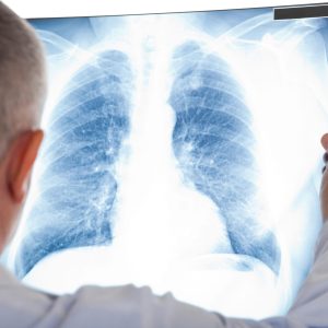 Doctor examining a lung radiography