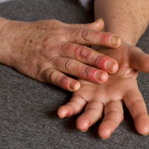 Reddened hands of woman with Raynauds syndrome